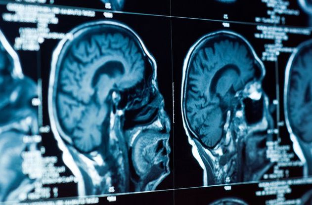 cerveau étude depression