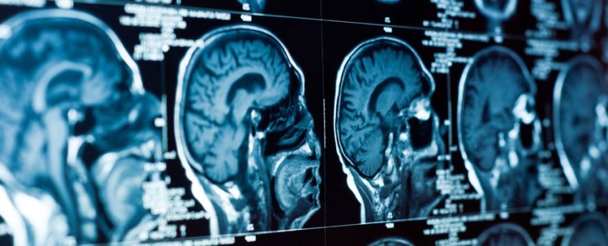 cerveau étude depression