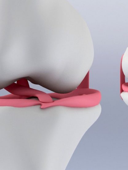 genou menisque cartilage hydrogel