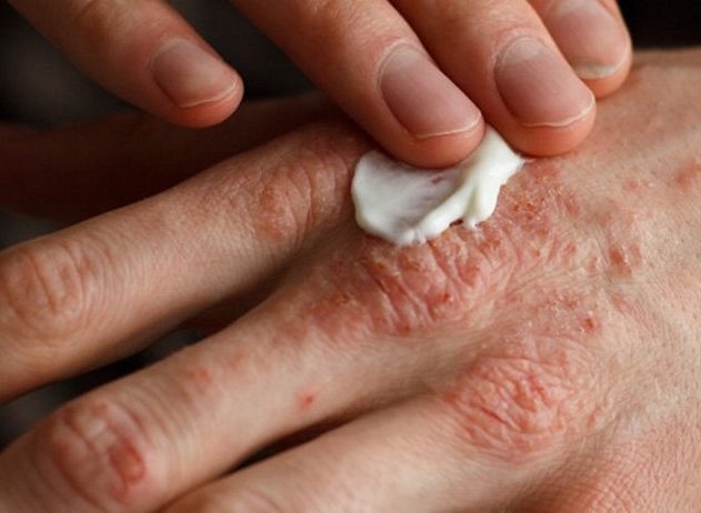 eczema lotion crème filaggrine dermatite atopique proteine gene