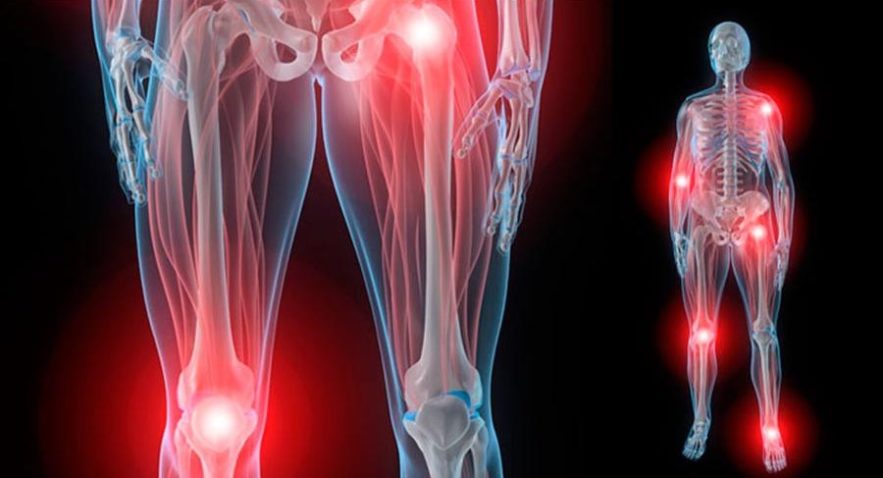 arthrite, génétique, évolution, migration