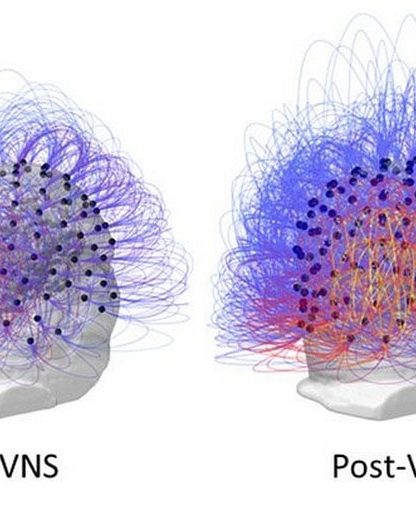 simulation VNS cerveau electrodes conscience reponse