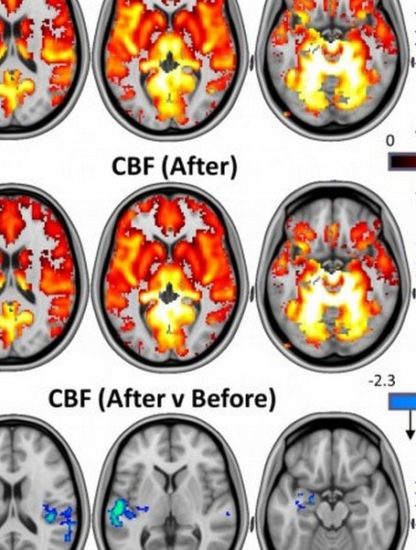 cerveau psychédélique dépression champignons magiques