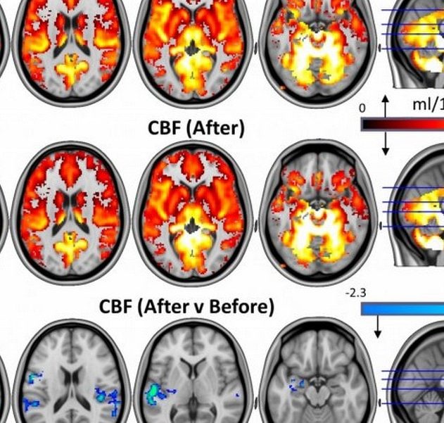 cerveau psychédélique dépression champignons magiques