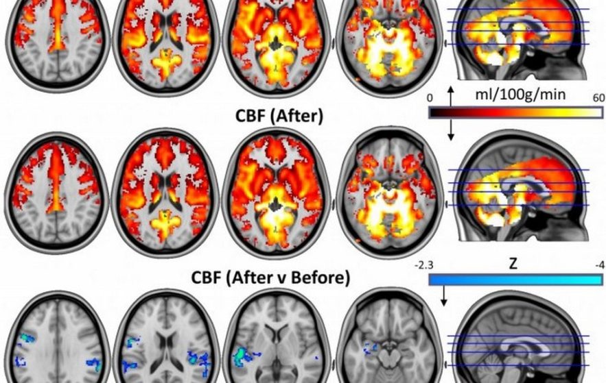 cerveau psychédélique dépression champignons magiques