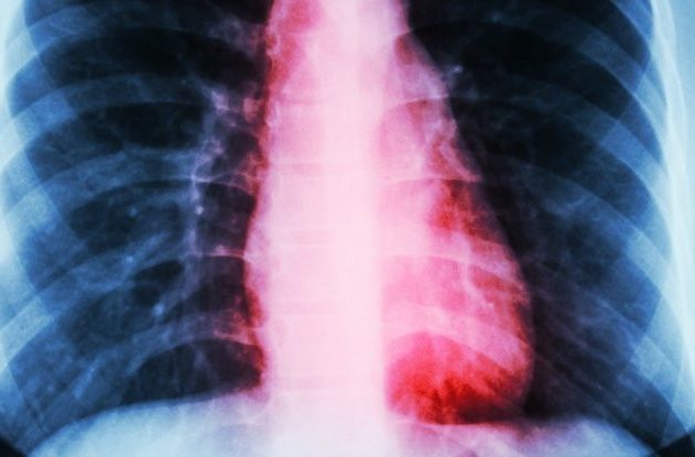 coeur brisé syndrome clinique cardiaque