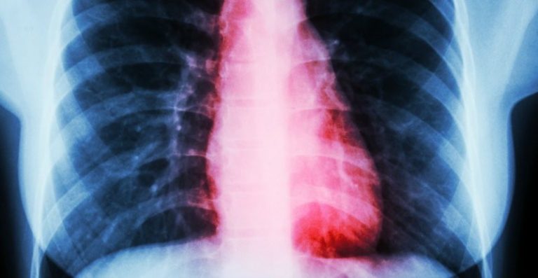 coeur brisé syndrome clinique cardiaque