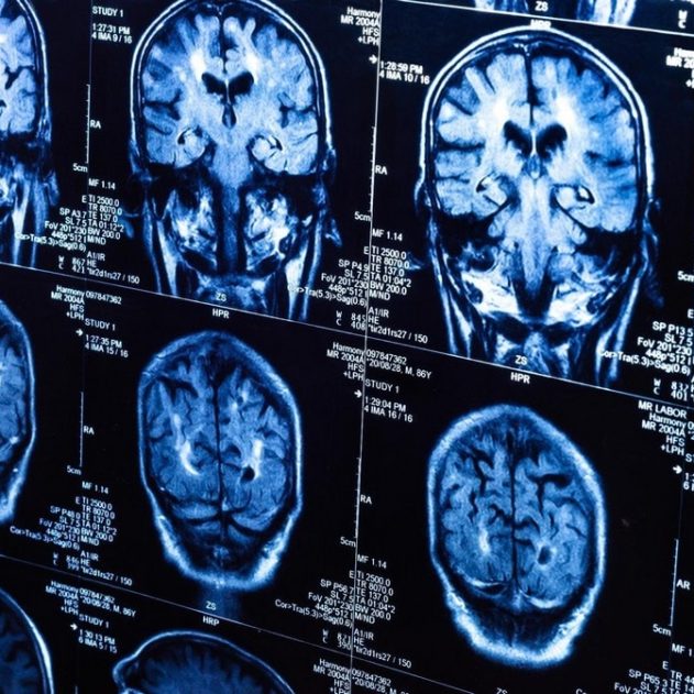 cerveau irm irmf imagerie résonnance réponse suivi tracking pensée timing