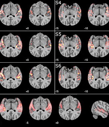 cerveau reconnaitre musique irm