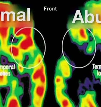 cerveau traumatisme comparaison pet scan