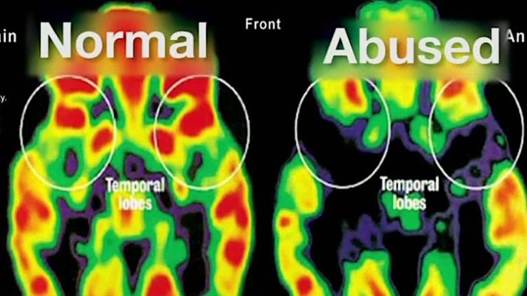 cerveau traumatisme comparaison pet scan