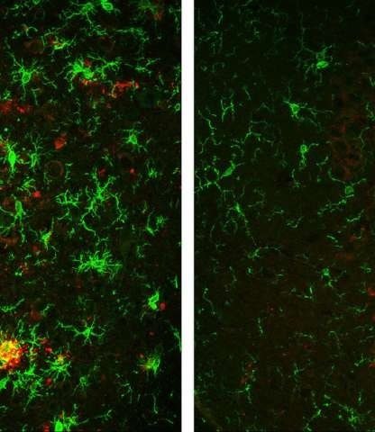 diminution plaques amyloides maladie alzheimer