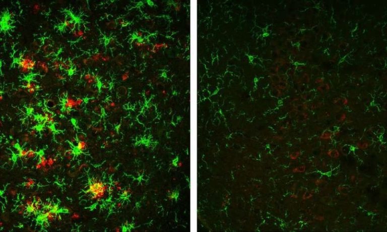 diminution plaques amyloides maladie alzheimer