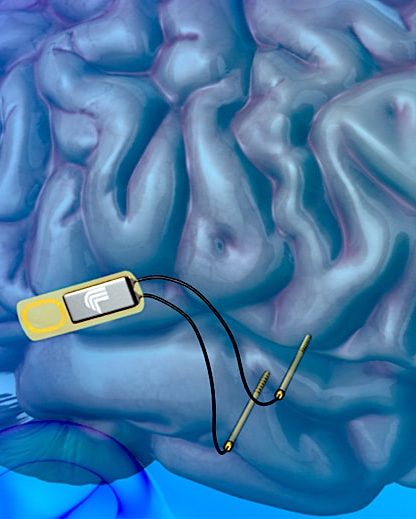 implant cerebral