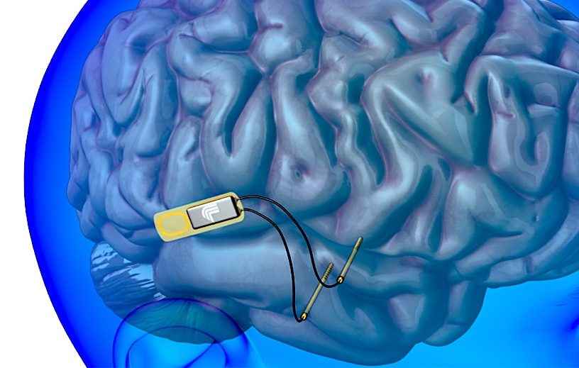 implant cerebral