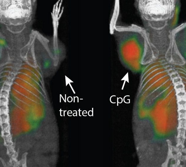 vaccin tumeur cancer éradiquer traitement immunothérapie système immunitaire