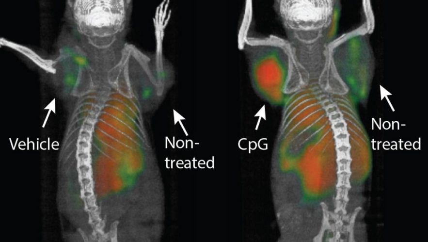 vaccin tumeur cancer éradiquer traitement immunothérapie système immunitaire