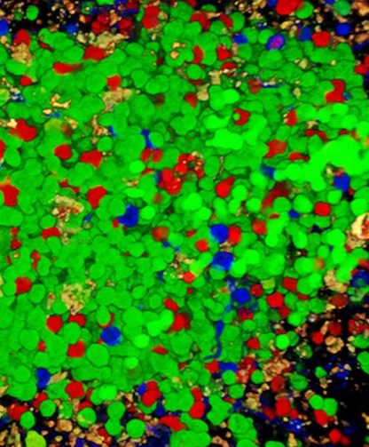 cellule b lymphocyte système immunitaire maladie auto immune