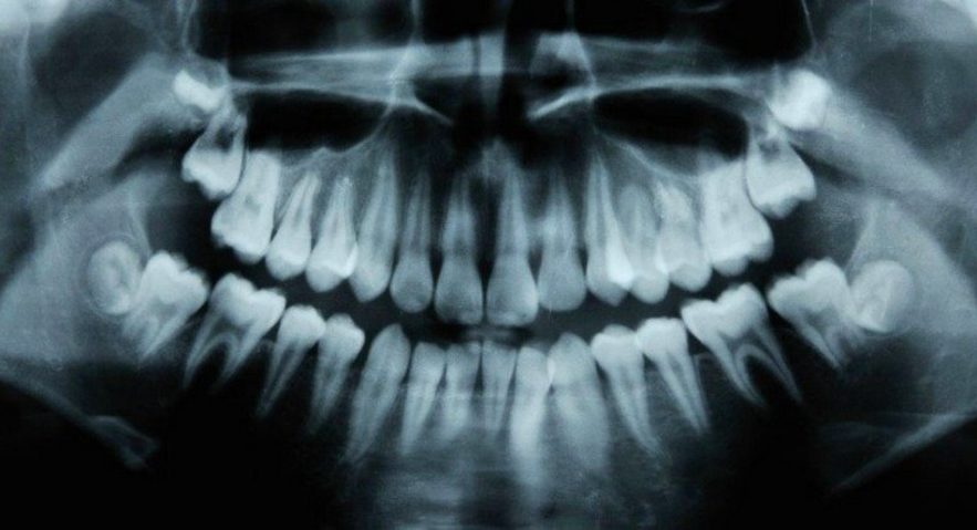 dents irm caries cavité naturel traitement