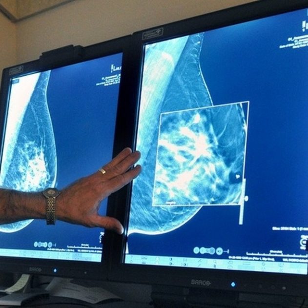 cancer sein traitement nouveau guerison retablissement