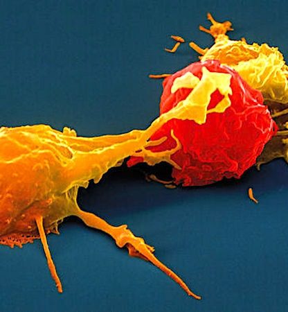 cellules tueuses naturelles-traitement cancer