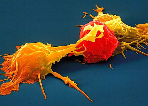 cellules tueuses naturelles-traitement cancer
