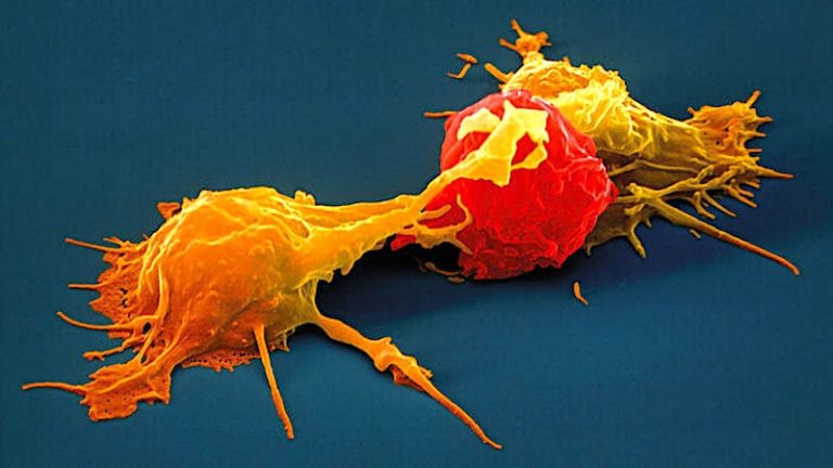cellules tueuses naturelles-traitement cancer