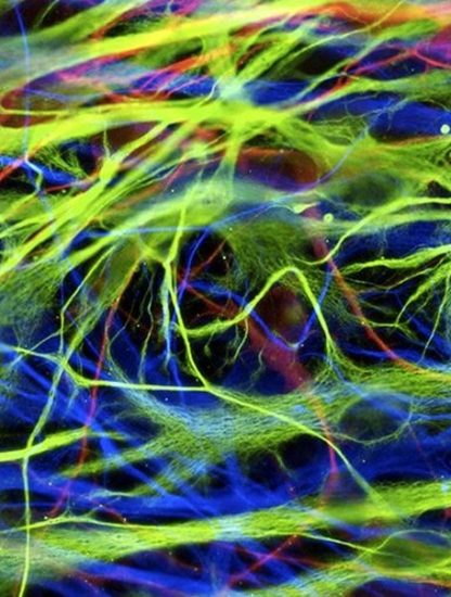 cellules souches reprogrammes implantees maladie parkinson