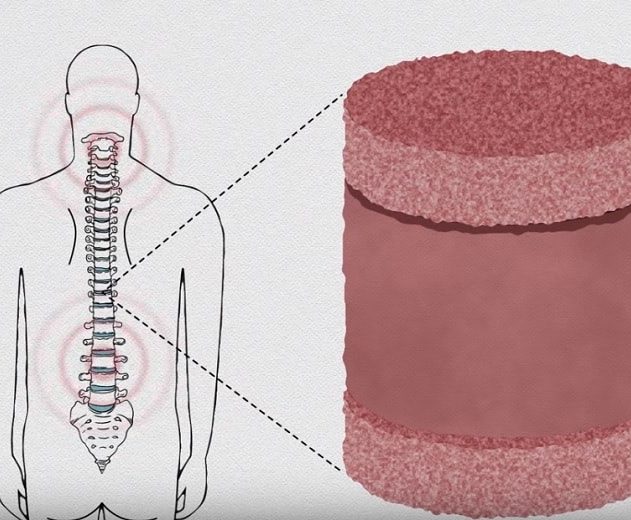 disques intervertebrauxc artificiels