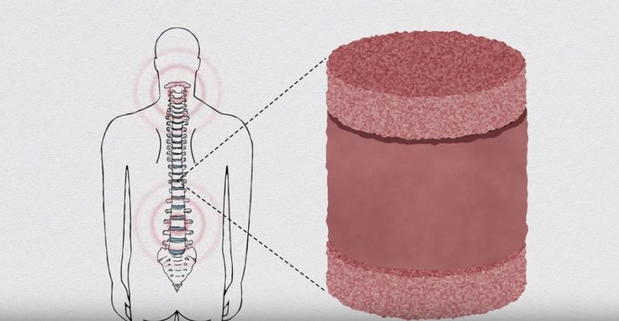 disques intervertebrauxc artificiels