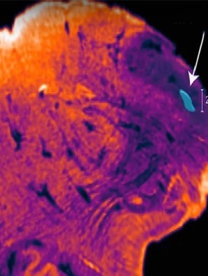 noyau endorestiforme cerveau humain