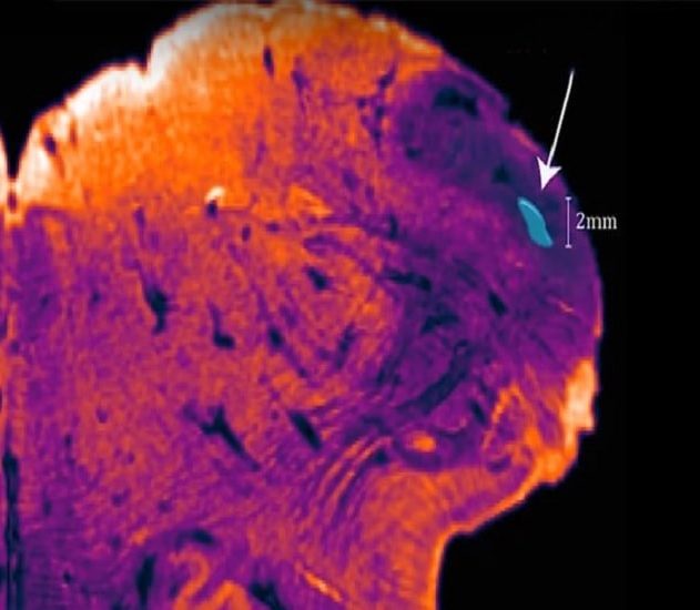 noyau endorestiforme cerveau humain