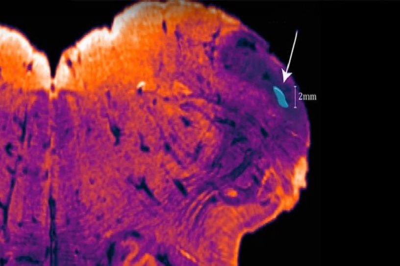 noyau endorestiforme cerveau humain