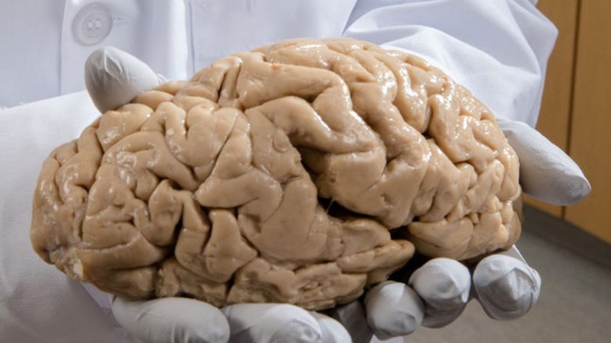 cerveau anatomie autisme trouble neurologique neurologie schizophrenie bipolaire