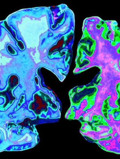 cerveau maladie alzheimer neurodegenerative cellules proteine tau beta amyloide