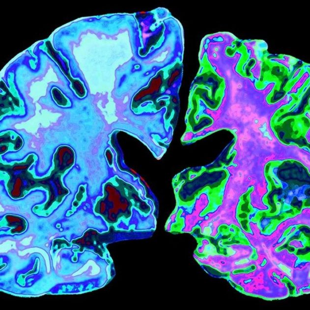 cerveau maladie alzheimer neurodegenerative cellules proteine tau beta amyloide