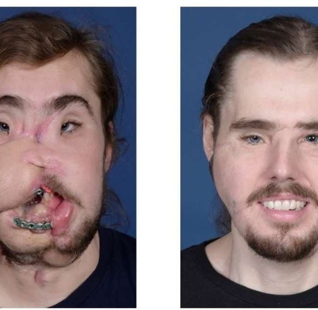transplantation visage underwood