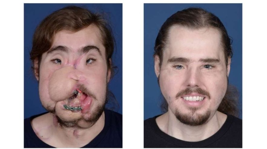 transplantation visage underwood