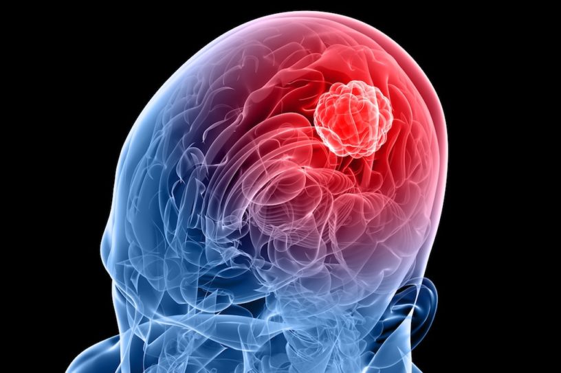 tumeur cerveau glioblastome