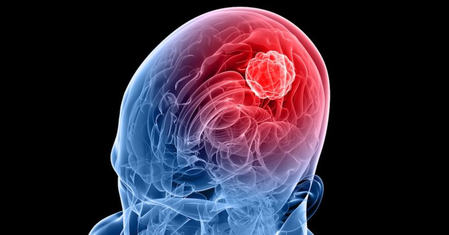 tumeur cerveau glioblastome