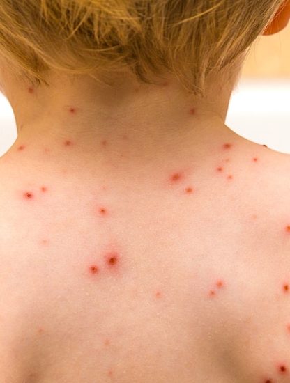 varicelle epidemie etats unis pas vaccin