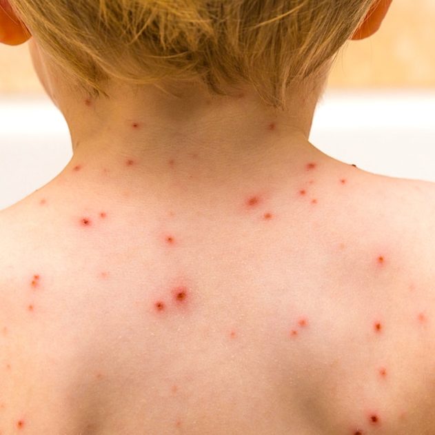 varicelle epidemie etats unis pas vaccin