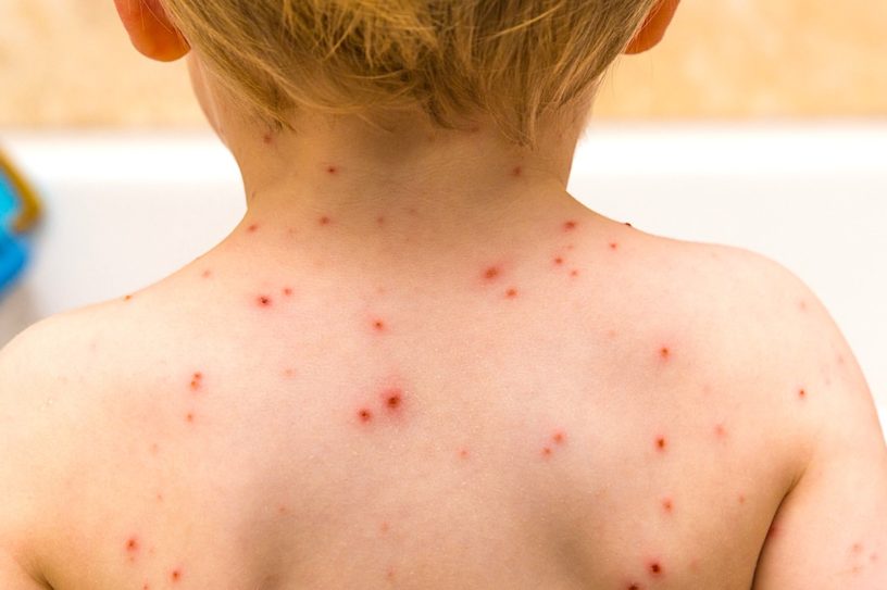 varicelle epidemie etats unis pas vaccin