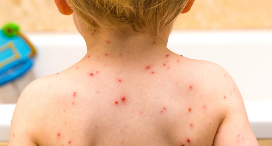 varicelle epidemie etats unis pas vaccin