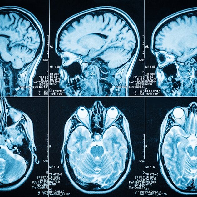 cerveau scanner matiere grise