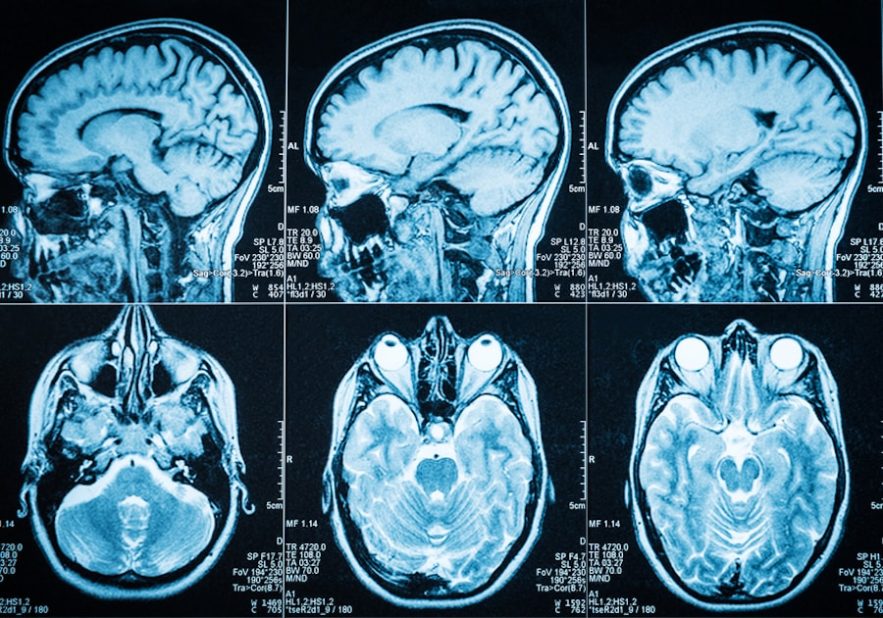 cerveau scanner matiere grise