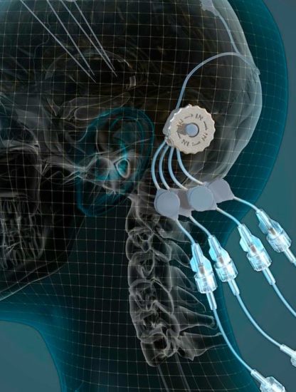 parkinson appareil gdnf