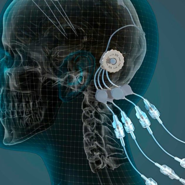 parkinson appareil gdnf