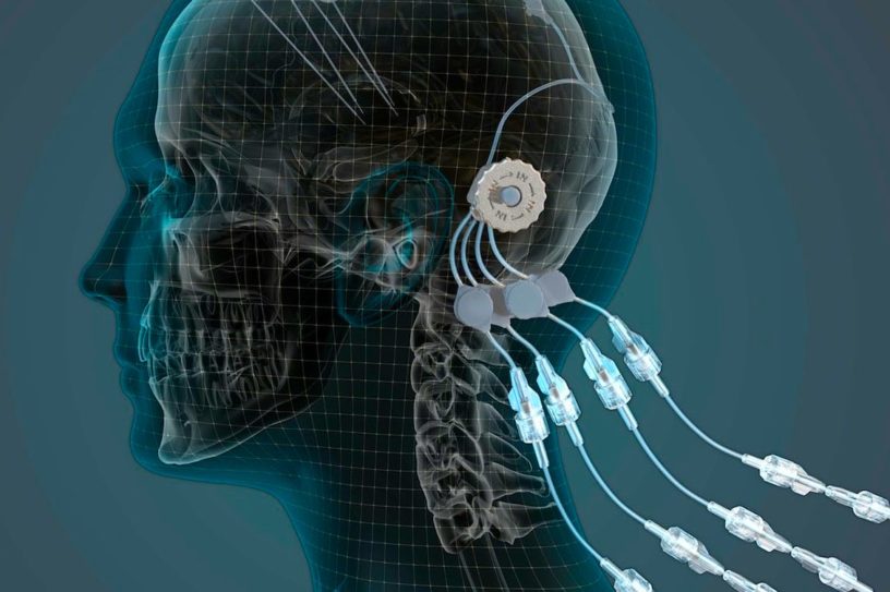 parkinson appareil gdnf