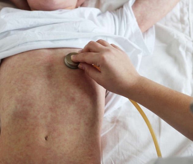 rougeole enfant touristes francais costa rica maladie introduction vaccin vaccination virus
